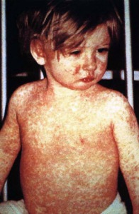 measles pic 1