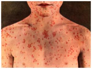 measles pic 2